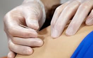 THERAPEUTIC DRY NEEDLING